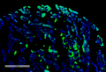 Rabbit Anti-Thymidine Glyclol Antibody [B29] used in Immunohistochemistry (IHC) on Human renal cancer (SMC-611)