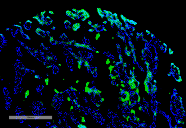 Rabbit Anti-Thymidine Glyclol Antibody [B29] used in Immunohistochemistry (IHC) on Human renal cancer (SMC-611)