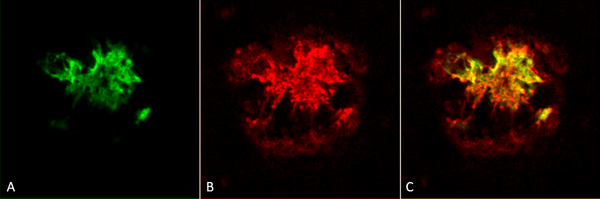 Rabbit Anti-Amyloid Oligomers (A11) Antibody used in Immunohistochemistry (IHC) on Alzheimer's Disease brain (SPC-506)