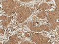 Rabbit Anti-ROR1 Antibody used in Immunohistochemistry (IHC) on Breast Cancer (SPC-762)