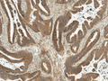 Rabbit Anti-MDM2 Antibody used in Immunohistochemistry (IHC) on Stomach Cancer (SPC-778)