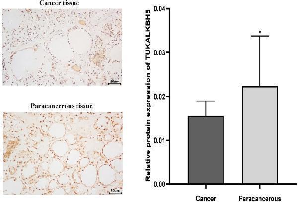 Comparison of human samples through immunohistochemical detection of ALKBH5 expression. ( * P < 0.05 indicates a significant difference between the indicated groups). 
Index in PubMed under a CC BY license. PMID: 39789120