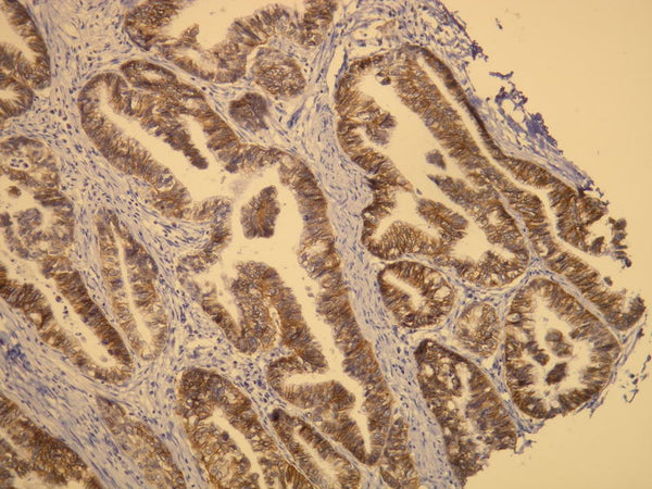 Anti-C-erb-2 (Her-2/neu) – Figure 1 of 2