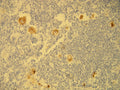 HRS cells of classical Hodgkin lymphoma showing cytoplasmic EBV LMP-1 expression, anti-EBV LMP-1 (DB 061), IHC.