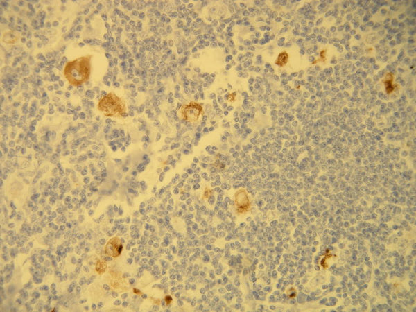 HRS cells of classical Hodgkin lymphoma showing cytoplasmic EBV LMP-1 expression, anti-EBV LMP-1 (DB 061), IHC.