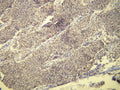 Diffuse nuclear progesterone receptor (PR) expression in meningothelial meningioma, anti-PR (DB 109), IHC.
