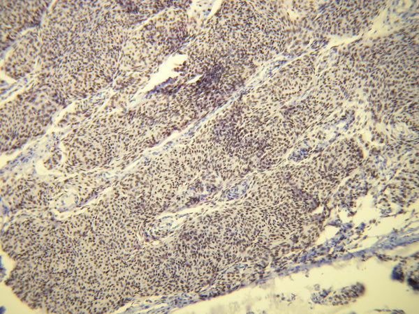 Diffuse nuclear progesterone receptor (PR) expression in meningothelial meningioma, anti-PR (DB 109), IHC.