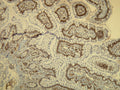 Anti-BRAF – Figure 1 of 2