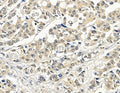 DF9094 at 1/100 staining human prostate cancer by IHC-P. The sample was formaldehyde fixed and a heat mediated antigen retrieval step in citrate buffer was performed. The sample was then blocked and incubated with the primary antibody at 4°C overnight. An HRP conjugated anti-rabbit antibody was used as the secondary antibody.