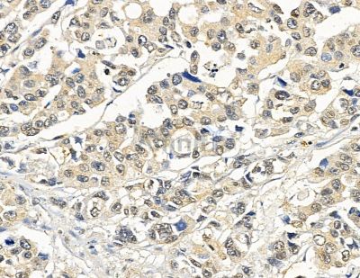 DF9094 at 1/100 staining human prostate cancer by IHC-P. The sample was formaldehyde fixed and a heat mediated antigen retrieval step in citrate buffer was performed. The sample was then blocked and incubated with the primary antibody at 4°C overnight. An HRP conjugated anti-rabbit antibody was used as the secondary antibody.