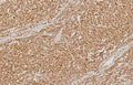IHC staining of FFPE human colon carcinoma tissue with PMS2 antibody (clone PMS2/8374R). HIER: boil tissue sections in pH 9 10mM Tris with 1mM EDTA for 20 min and allow to cool before testing.