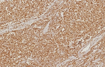 IHC staining of FFPE human colon carcinoma tissue with PMS2 antibody (clone PMS2/8374R). HIER: boil tissue sections in pH 9 10mM Tris with 1mM EDTA for 20 min and allow to cool before testing.
