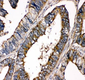 Immunohistochemical staining of FFPE human colon cancer tissue with SHP-2 antibody, HRP-secondary and DAB substrate. HIER: boil tissue sections in pH8 EDTA for 20 min and allow to cool before testing.