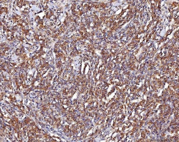 IHC staining of FFPE human lymphoma tissue with ENO1 antibody. HIER: boil tissue sections in pH8 EDTA for 20 min and allow to cool before testing.