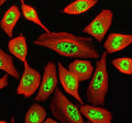 Immunofluorescent staining of SON using anti-SON antibody (red). SON was detected in a paraffin-embedded section of human liver cancer tissue. Heat mediated antigen retrieval was performed in EDTA buffer (pH 8.0, epitope retrieval solution). The tissue section was blocked with 10% goat serum. The tissue section was then incubated with 5 ug/ml rabbit anti-SON antibody overnight at 4oC. Cy3 Conjugated Goat Anti-Rabbit IgG was used as secondary antibody at 1:500 dilution and incubated for 30 min at 37oC.