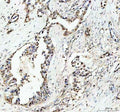 IHC staining of FFPE human pancreas cancer tissue with c-Myb antibody. HIER: boil tissue sections in pH8 EDTA for 20 min and allow to cool before testing.