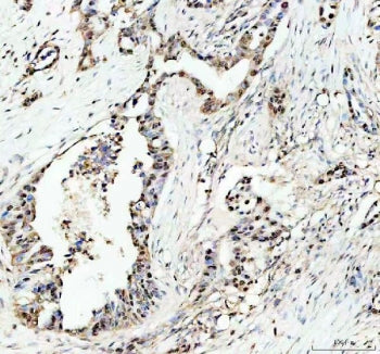 IHC staining of FFPE human pancreas cancer tissue with c-Myb antibody. HIER: boil tissue sections in pH8 EDTA for 20 min and allow to cool before testing.