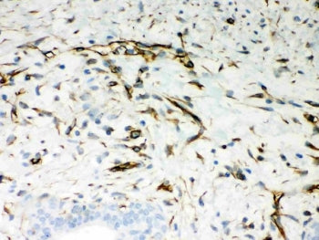 IHC-P: Vimentin antibody testing of human breast cancer tissue. Required HIER: boil tissue sections in pH8 EDTA for 20 min and allow to cool before testing.