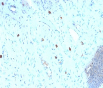 IHC staining of FFPE human cervix with recombinant HPV16 L1 antibody (clone HPV16/2058R). Required HIER: boil tissue sections in pH9 EDTA buffer for 45 min followed by cooling at RT for 20 min.