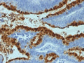 Lewis b Antibody Colon Carcinoma IHC. Immunohistochemistry analysis of FFPE human colon carcinoma tissue stained with Lewis b Antibody demonstrates strong membranous and apical HRP-DAB brown staining throughout glandular epithelial tumor cell populations, consistent with expression of Lewis b-associated carbohydrate antigens within gastrointestinal-derived carcinoma tissue.