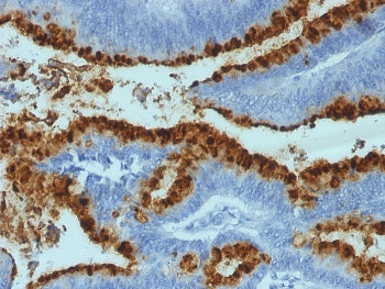 Lewis b Antibody Colon Carcinoma IHC. Immunohistochemistry analysis of FFPE human colon carcinoma tissue stained with Lewis b Antibody demonstrates strong membranous and apical HRP-DAB brown staining throughout glandular epithelial tumor cell populations, consistent with expression of Lewis b-associated carbohydrate antigens within gastrointestinal-derived carcinoma tissue.
