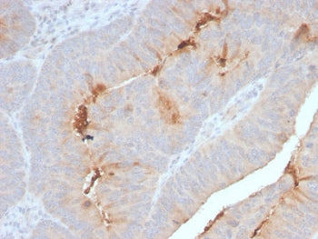 IHC staining of FFPE human colon carcinoma with recombinant SAA antibody. HIER: boil tissue sections in 10mM Tris with 1mM EDTA, pH 9, for 10-20 min and allow to cool before testing.