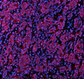 Immunofluorescent staining of STXBP3 using anti-STXBP3 antibody (red). STXBP3 was detected in a paraffin-embedded section of human breast cancer tissue. Heat mediated antigen retrieval was performed in EDTA buffer (pH 8.0, epitope retrieval solution). The tissue section was blocked with 10% goat serum. The tissue section was then incubated with 5 ug/ml rabbit anti-STXBP3 antibody overnight at 4oC.