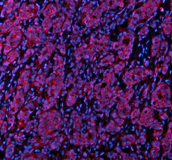 Immunofluorescent staining of STXBP3 using anti-STXBP3 antibody (red). STXBP3 was detected in a paraffin-embedded section of human breast cancer tissue. Heat mediated antigen retrieval was performed in EDTA buffer (pH 8.0, epitope retrieval solution). The tissue section was blocked with 10% goat serum. The tissue section was then incubated with 5 ug/ml rabbit anti-STXBP3 antibody overnight at 4oC.