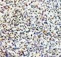Immunohistochemical staining of TERF2IP using anti-TERF2IP antibody. TERF2IP was detected in a paraffin-embedded section of human lymphoma tissue. Heat mediated antigen retrieval was performed in EDTA buffer (pH 8.0, epitope retrieval solution). The tissue section was blocked with 10% goat serum. The tissue section was then incubated with 2 ug/ml rabbit anti-TERF2IP antibody overnight at 4oC. Peroxidase Conjugated Goat Anti-rabbit IgG was used as secondary antibody and incubated for 30 min at 37oC.