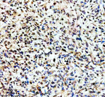 Immunohistochemical staining of TERF2IP using anti-TERF2IP antibody. TERF2IP was detected in a paraffin-embedded section of human lymphoma tissue. Heat mediated antigen retrieval was performed in EDTA buffer (pH 8.0, epitope retrieval solution). The tissue section was blocked with 10% goat serum. The tissue section was then incubated with 2 ug/ml rabbit anti-TERF2IP antibody overnight at 4oC. Peroxidase Conjugated Goat Anti-rabbit IgG was used as secondary antibody and incubated for 30 min at 37oC.
