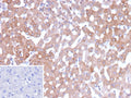 IHC staining of FFPE human hepatocellular carcinoma tissue with 17-beta-hydroxysteroid dehydrogenase 13 antibody (clone HSD17B13/13109). Inset: PBS used in place of primary Ab (secondary Ab negative control). HIER: boil tissue sections in pH 9 10mM Tris with 1mM EDTA for 20 min and allow to cool before testing.