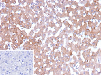 IHC staining of FFPE human hepatocellular carcinoma tissue with 17-beta-hydroxysteroid dehydrogenase 13 antibody (clone HSD17B13/13109). Inset: PBS used in place of primary Ab (secondary Ab negative control). HIER: boil tissue sections in pH 9 10mM Tris with 1mM EDTA for 20 min and allow to cool before testing.