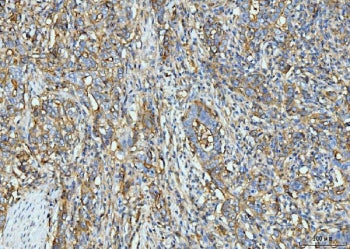 IHC staining of FFPE human rectal moderately differentiated adenocarcinoma tissue with Intercellular adhesion molecule 1 antibody. HIER: boil tissue sections in pH8 EDTA for 20 min and allow to cool before testing.