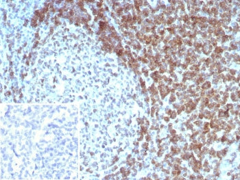 IHC staining of FFPE human tonsil tissue with CD3 delta antibody (clone CD3D/8898). Inset: PBS used in place of primary Ab (secondary Ab negative control). HIER: boil tissue sections in pH 9 10mM Tris with 1mM EDTA for 20 min and allow to cool before testing.