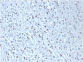 IHC testing of FFPE human mesothelioma with WT1 antibody cocktail (clone WT1/857 + 6F-H2). Required HIER: boil tissue sections in pH 9 10mM Tris with 1mM EDTA for 10-20 min followed by cooling at RT for 20 min.