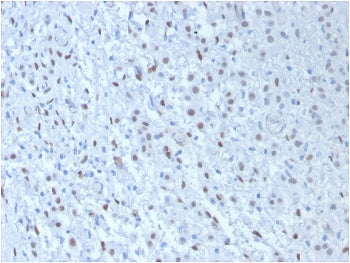 IHC testing of FFPE human mesothelioma with WT1 antibody cocktail (clone WT1/857 + 6F-H2). Required HIER: boil tissue sections in pH 9 10mM Tris with 1mM EDTA for 10-20 min followed by cooling at RT for 20 min.