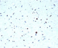 IHC staining of FFPE human rhabdomyosarcoma tissue with recombinant PAX7 antibody (clone PAX7/7079R). HIER: boil tissue sections in pH 9 10mM Tris with 1mM EDTA for 20 min and allow to cool before testing.