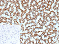 IHC staining of FFPE human hepatocellular carcinoma tissue with CPS1 antibody (clone CPS1/9857). Inset: PBS used in place of primary Ab (secondary Ab negative control). HIER: boil tissue sections in pH 9 10mM Tris with 1mM EDTA for 20 min and allow to cool before testing.