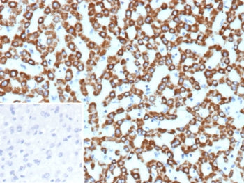 IHC staining of FFPE human hepatocellular carcinoma tissue with CPS1 antibody (clone CPS1/9857). Inset: PBS used in place of primary Ab (secondary Ab negative control). HIER: boil tissue sections in pH 9 10mM Tris with 1mM EDTA for 20 min and allow to cool before testing.