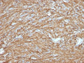 IHC testing of FFPE human gastrointestinal stromal tumor (GIST) with TMEM16A antibody (clone DG1/2831R). Required HIER: boil tissue sections in pH 9 10mM Tris with 1mM EDTA for 10-20 min followed by cooling at RT for 20 min.