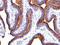 Formalin-fixed, paraffin-embedded human ovarian carcinoma stained with EMA antibody (MUC1/845).