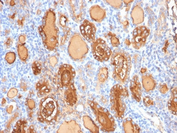 IHC: Formalin-fixed, paraffin-embedded human thyroid gland stained with recombinant Thyroglobulin antibody (clone r2H11). Required HIER: boil tissue sections in pH 9 10mM Tris with 1mM EDTA for 10-20 min followed by cooling at RT for 20 min.