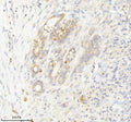 Immunohistochemical staining of INTS4 using anti-INTS4 antibody. INTS4 was detected in a paraffin-embedded section of human thyroid cancer tissue. Heat mediated antigen retrieval was performed in EDTA buffer (pH 8.0, epitope retrieval solution). The tissue section was blocked with 10% goat serum. The tissue section was then incubated with 2 ug/ml rabbit anti-INTS4 antibody overnight at 4oC. Peroxidase Conjugated Goat Anti-rabbit IgG was used as secondary antibody and incubated for 30 min at 37oC.