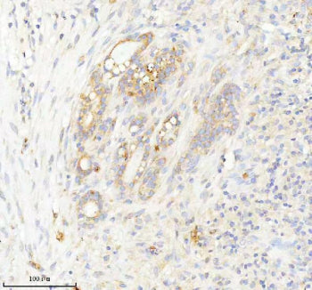 Immunohistochemical staining of INTS4 using anti-INTS4 antibody. INTS4 was detected in a paraffin-embedded section of human thyroid cancer tissue. Heat mediated antigen retrieval was performed in EDTA buffer (pH 8.0, epitope retrieval solution). The tissue section was blocked with 10% goat serum. The tissue section was then incubated with 2 ug/ml rabbit anti-INTS4 antibody overnight at 4oC. Peroxidase Conjugated Goat Anti-rabbit IgG was used as secondary antibody and incubated for 30 min at 37oC.