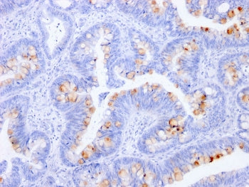 IHC staining of FFPE human colon with CEA antibody (clone C66/1291). HIER: boil tissue sections in pH 9 10mM Tris with 1mM EDTA for 10-20 min and allow to cool before testing.