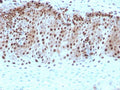 IHC staining of FFPE human cervical carcinoma with recombinant c-Myc antibody. HIER: boil tissue sections in pH 9 10mM Tris with 1mM EDTA for 20 min and allow to cool before testing.