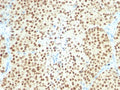 IHC testing of FFPE melanoma with recombinant SOX10 antibody (clone SOX10/2311R). Required HIER: boil sections in pH 9 10mM Tris with 1mM EDTA for 10-20 minutes, followed by cooling at RT for 20 minutes, prior to staining.