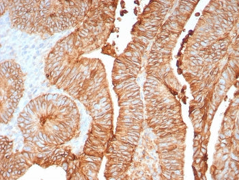 IHC staining of FFPE human colon tissue with CDH17 antibody (clone CDH17/8158R). Inset: PBS used in place of primary Ab (secondary Ab negative control). HIER: boil tissue sections in pH 9 10mM Tris with 1mM EDTA for 20 min and allow to cool before testing.