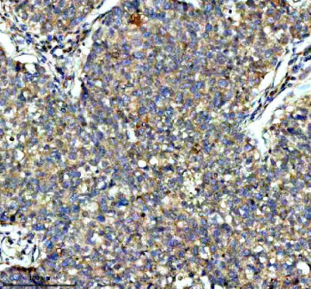 IHC analysis of KCNA6 using anti-KCNA6 antibody. KCNA6 was detected in a paraffin-embedded section of human testis cancer tissue. Heat mediated antigen retrieval was performed in EDTA buffer (pH 8.0, epitope retrieval solution). The tissue section was blocked with 10% goat serum. The tissue section was then incubated with 2 ug/ml rabbit anti-KCNA6 antibody overnight at 4oC. Peroxidase Conjugated Goat Anti-rabbit IgG was used as secondary antibody and incubated for 30 min at 37oC.