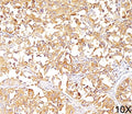 IHC staining of human melanoma (10X) with gp100 antibody (clone HMB45). HIER: boil tissue sections in pH 9 10mM Tris with 1mM EDTA for 20 min and allow to cool before testing.
